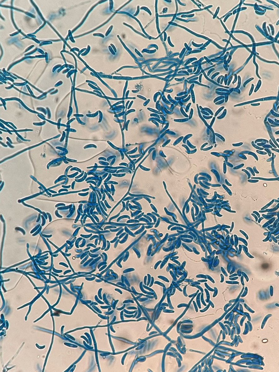 kakule06's tweet photo. @MayoClinicINFD Invasive Fusariosis (Fusarium sp.) https://t.co/KVr1UnwYue