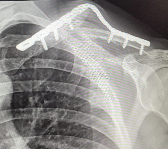 “Quedó verguísima mi cirugía me parece una gran idea VOLVER A SUBIRME A LA MOTO”