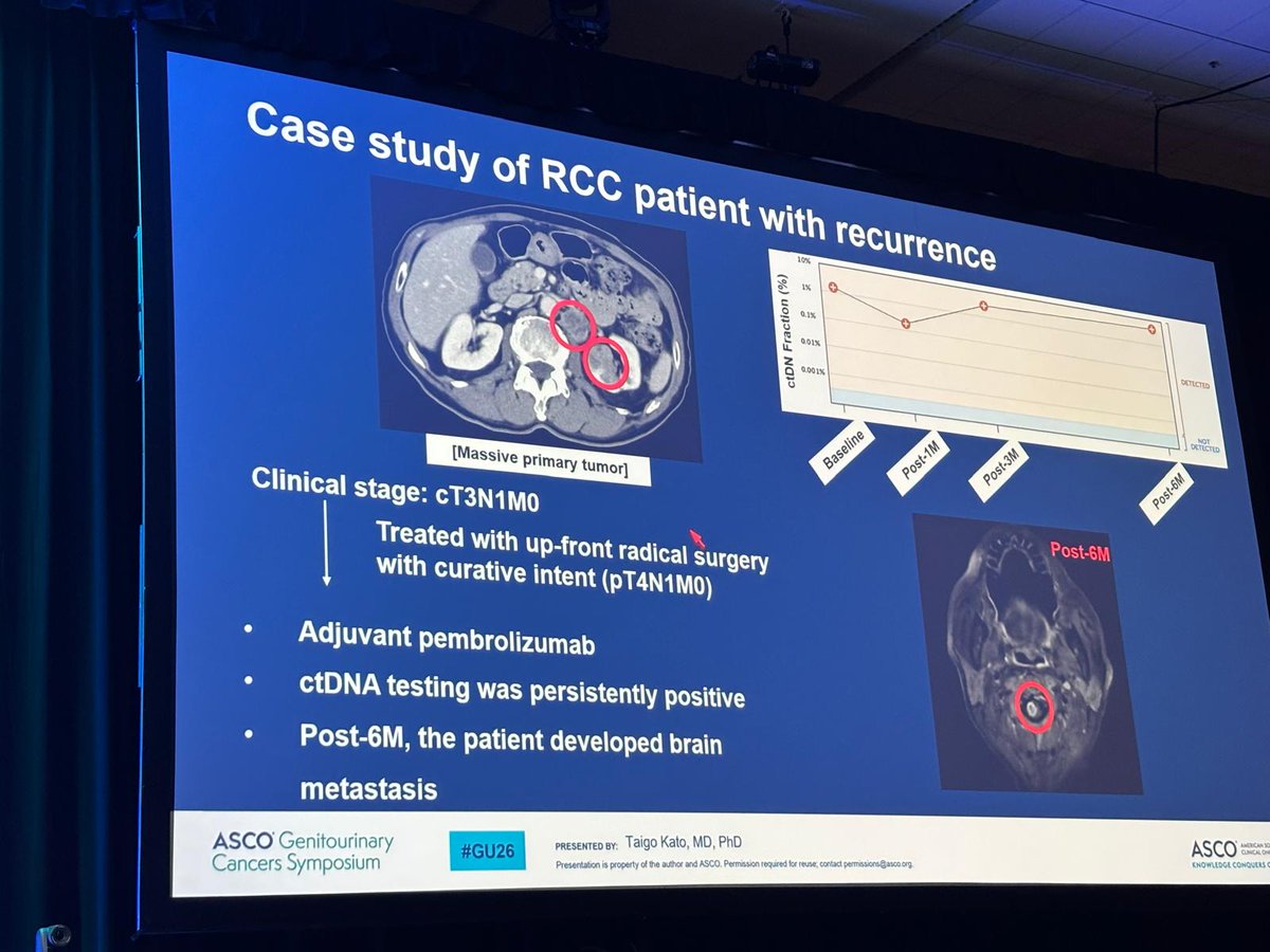 DrChoueiri's tweet photo. Dr. Kato on MONSTAR-SCREEN-3.
Ultra-sensitive ctDNA MRD in resectable RCC:
- Feasible in 100% of patients (16/16)
- Baseline ctDNA detected in 100%; 50% at ultra-low levels
- Post-op MRD+ rates (small numbers): 13.3% (1 mo), 15.4% (3 mo), 10% (6 mo)
- In the only recurrence so far, MRD led imaging by  around 4.4 months

Clinical outcomes are awaited to provide further insight into the role of ctDNA in RCC.

#GU26 
#RCC
@OncoAlert 
@OncBrothers