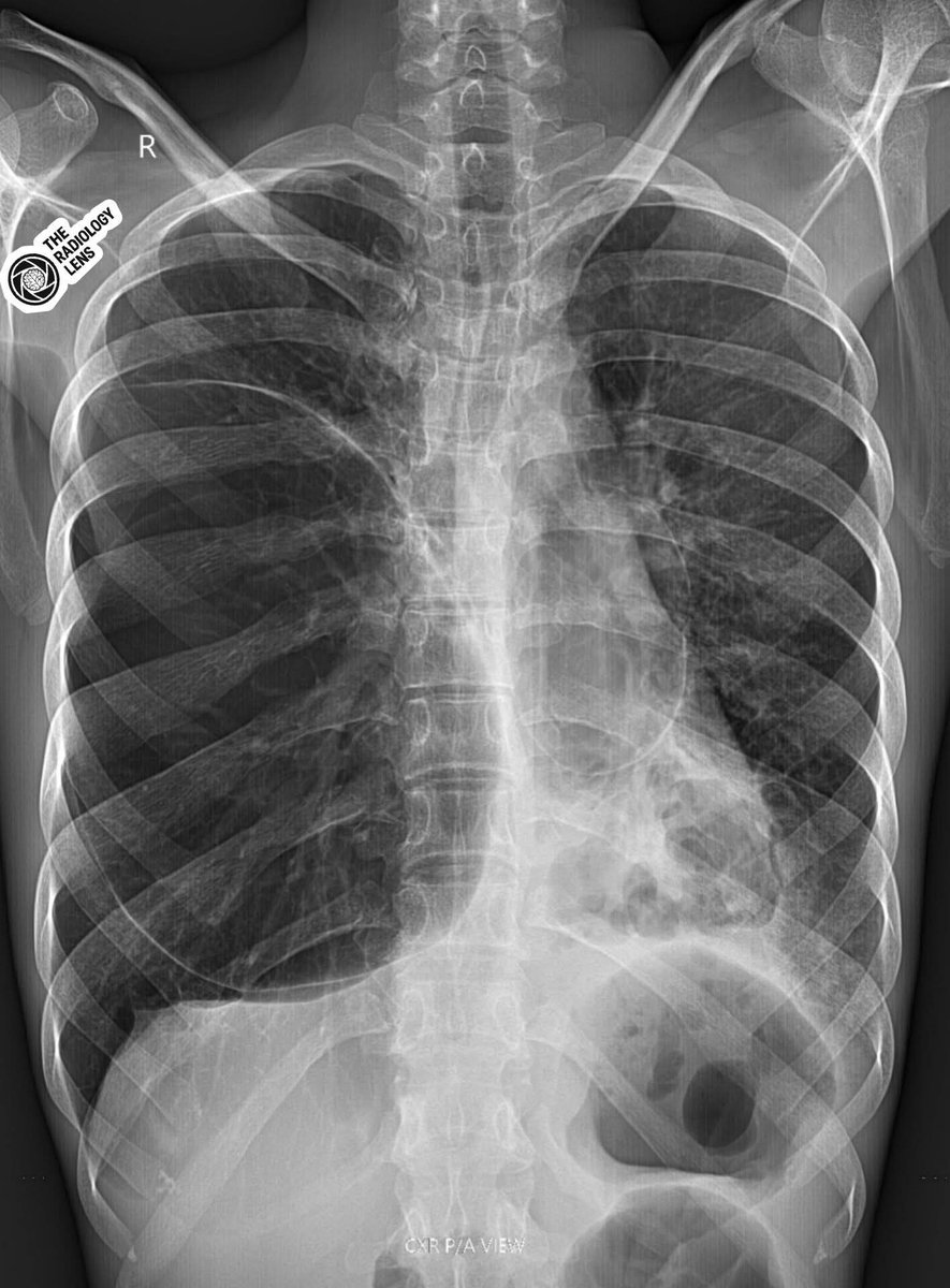 albertoortegana's tweet image. 22Y/M
C/C:  shortness of breath &amp;amp; cough.
#TheRadiologyLens
#Radiology#MedicalImaging
#DiagnosticImaging #RadiologyEducation 
@dr_manish_ydv @Dr_Shiv_kumar_ @DrAkhilX @DrMedica_13 @IhabFathiSulima @drobiy12 @hemo_shk