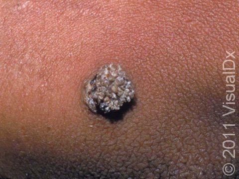 CallNisar's tweet image. Common wart can be one differential