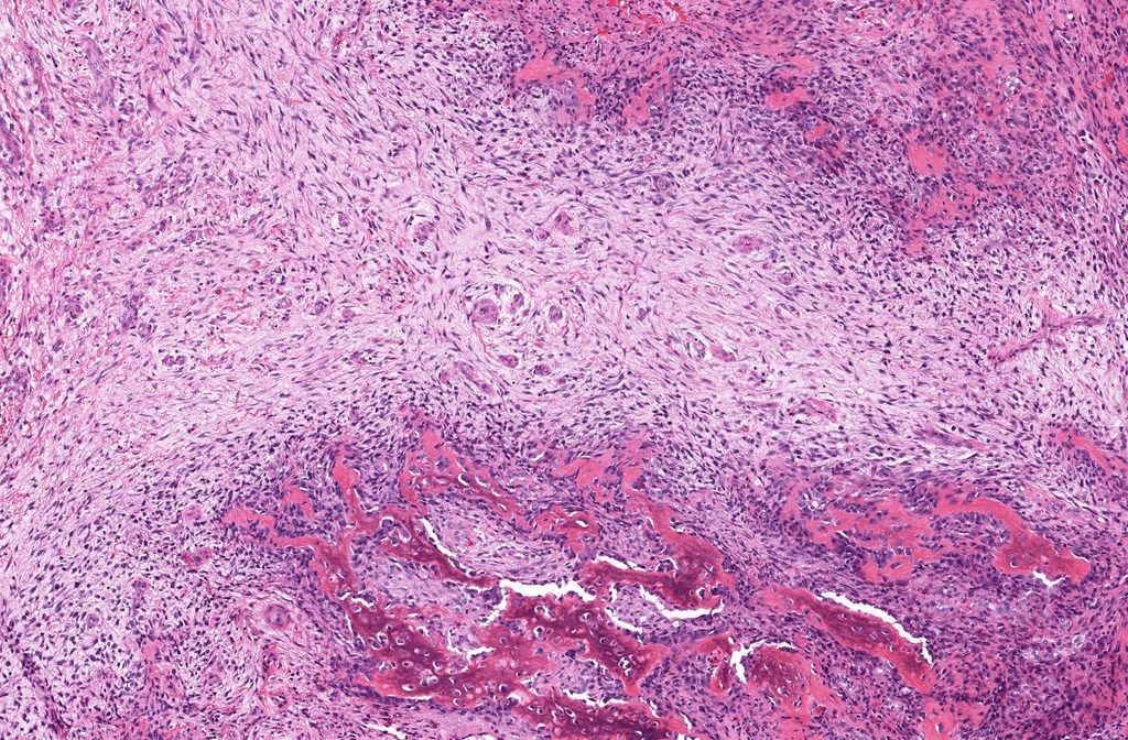 JMGardnerMD's tweet photo. 25 yo F with intramuscular arm mass.
Digital slide: https://t.co/voOhnYULlR
Radiology: https://t.co/vNwz24Qx2E
Answer ✅ https://t.co/aDwp5kZAUT
#BSTpath #pathologists #pathology #pathTwitter #radpathmatch https://t.co/EeVEEAezV6