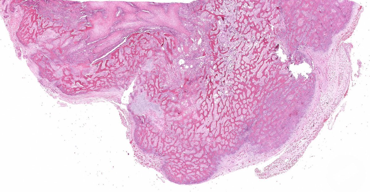JMGardnerMD's tweet photo. 25 yo F with intramuscular arm mass.
Digital slide: https://t.co/voOhnYULlR
Radiology: https://t.co/vNwz24Qx2E
Answer ✅ https://t.co/aDwp5kZAUT
#BSTpath #pathologists #pathology #pathTwitter #radpathmatch https://t.co/EeVEEAezV6