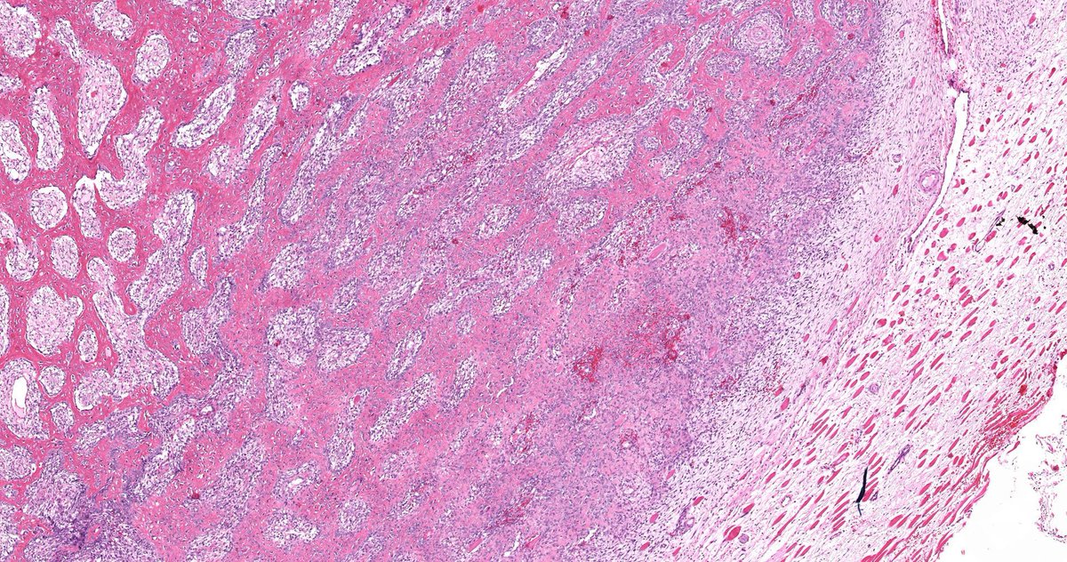JMGardnerMD's tweet photo. 25 yo F with intramuscular arm mass.
Digital slide: https://t.co/voOhnYULlR
Radiology: https://t.co/vNwz24Qx2E
Answer ✅ https://t.co/aDwp5kZAUT
#BSTpath #pathologists #pathology #pathTwitter #radpathmatch https://t.co/EeVEEAezV6