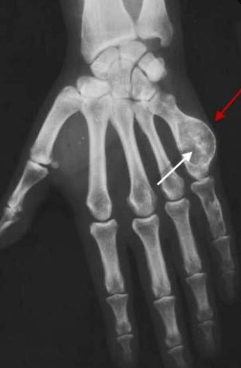 albertoortegana's tweet image. Whats your diagnosis?? Management???
#Orthopedics #xray 
#TumorBiology #Health 
@dr_manish_ydv @Dr_Shiv_kumar_ @DrAkhilX @DrMedica_13 @drobiy12 @hemo_shk