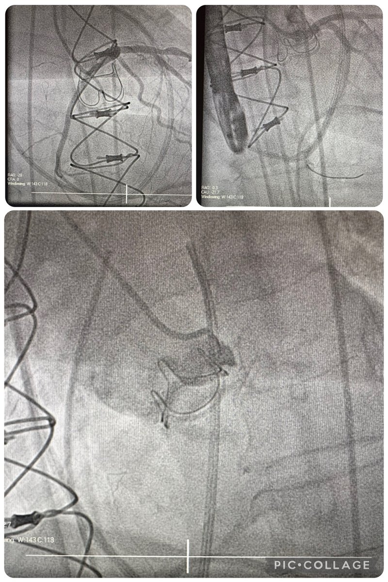 heshamafify90's tweet image. Emergent cath lab case straight from open-heart OR: cardiogenic shock + anterolateral WMA → found critical 99% ostial/prox LM stenosis (TIMI-1). LM PCI: NC balloon prep → Xience Skypoint 4.5×12 DES →Final angio: TIMI-3, 0% residual, no complications. #leftmainpci
