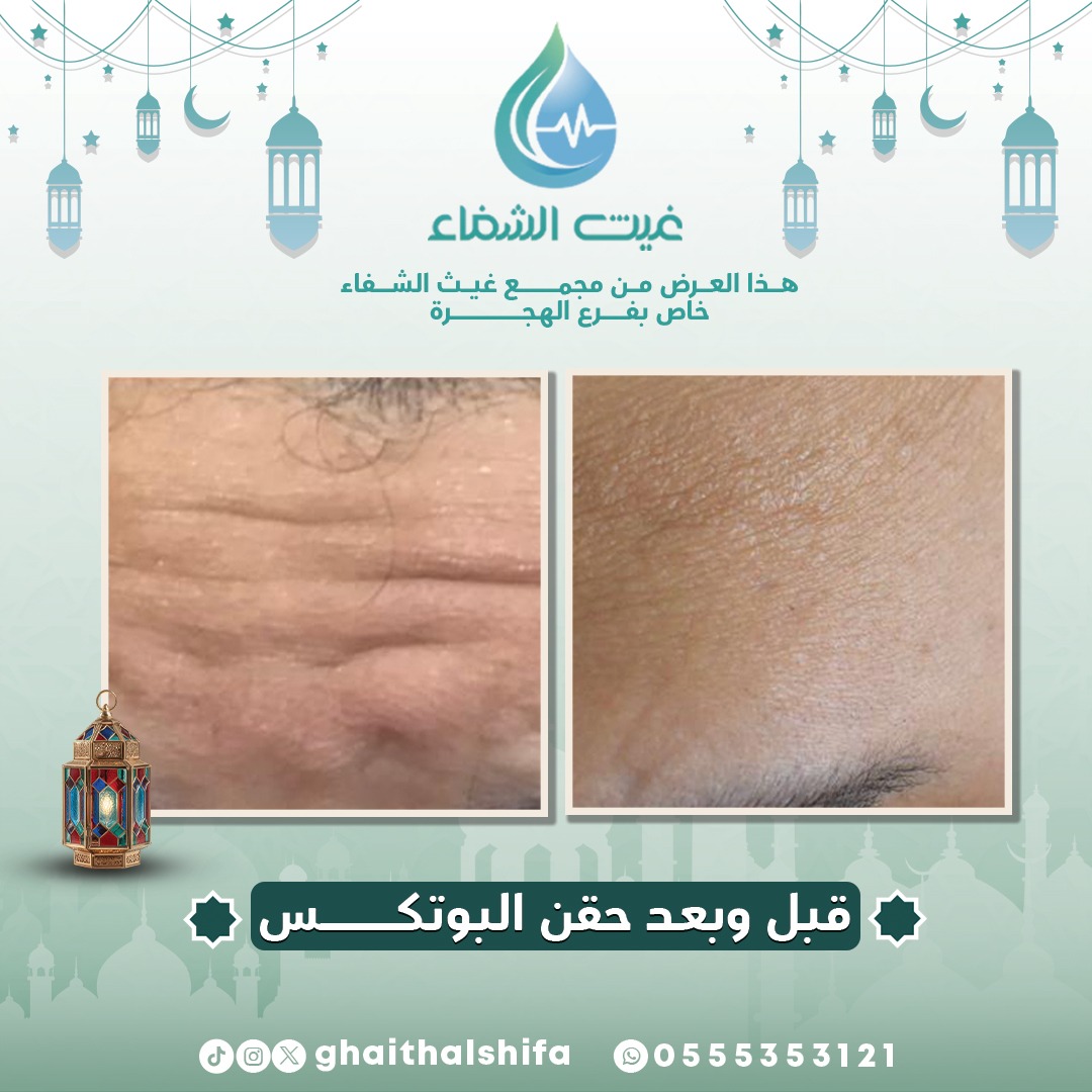 خطوط الجبهة مزعجتك؟ 🤔
مع البوتكس تودّعين التجاعيد وترجع بشرتك ناعمة ومشدودة ✨💉
فرق قبل وبعد يبان من أول جلسة 😍
#غيث_الشفاء #السعودية #المدينة_المنورة #طب #تجميل