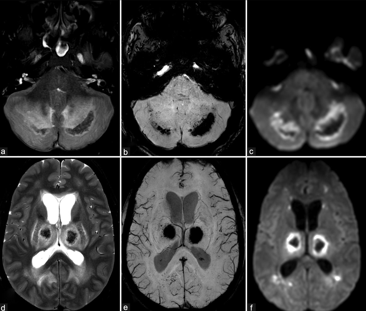 Annals of Indian Academy of Neurology tweet media