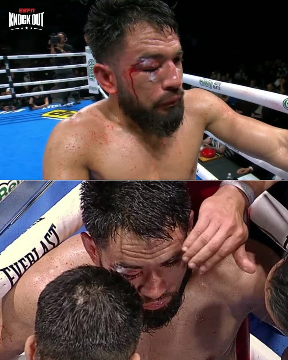 ESPNKnockOut's tweet image. ¡QUEDÓ BASTANTE LASTIMADO! 🤕

😬 Así quedó el Sugar Núñez, tras la pelea contra el Vaquero Navarrete.

Con justa razón pararon la pelea. 🥊