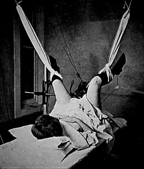 MrPitbull07's tweet photo. Her legs are lifted into fabric slings beneath a ceiling crowded with wires, and the machine above her hums with a sound that feels more industrial than medical. It is 1920, and this is what hope looks like when science is still learning how to fight cancer.

She lies on a narrow hospital bed with advanced cervical cancer, a diagnosis that in her time usually carries the quiet certainty of death. By spring, her physicians have marked her case as hopeless, with little left to offer beyond comfort.

There are no imaging scans mapping the tumor’s shape, no digital monitors calculating dosage with precision. There is only an X-ray tube, electrical current, and doctors willing to attempt something radical.

They suspend her legs not for dignity but for access, positioning her body carefully beneath the crude apparatus. The radiation beam is directed intra-vaginally toward the cervix in treatments that stretch nearly two hours at a time.

The room smells of heated metal and antiseptic as physicians document every detail of the experiment. They record the amperage of the tube, the distance from the radiation source, and the exact position of her body.

Radiation at the dawn of the twentieth century is both miracle and mystery. Doctors understand it can destroy tissue, but they do not yet fully grasp how deeply it can damage healthy cells along with malignant ones.

For this woman, the alternative is certain decline. Pain has become constant, weakness has hollowed her body, and conventional remedies have failed.

So she endures the hum of the machine and the invisible rays directed into her body. Each session feels like a negotiation between desperation and discovery.

Then something unexpected begins to happen. The tumor starts to shrink, and the malignant growth that once advanced relentlessly shows signs of retreat.

Her weight stabilizes, her blood work improves, and she reports a sense of well-being she has not felt in months. In a ward accustomed to loss, cautious optimism replaces resignation.

But the treatment exacts a price. She suffers intense nausea and fatigue, symptoms doctors describe as “X-ray sickness,” without fully understanding the biological cause.

There are no refined safety standards, no shielding protocols developed over decades of research. This is medicine operating at the edge of knowledge, guided by observation rather than certainty.

The image of her treatment is not taken to shock future generations. It is recorded to teach other physicians how to position the patient and manage the wires and rays.

What appears crude by modern standards is, in its moment, an act of scientific courage. The doctors believe that sharing their process may transform experiment into method.

Every modern radiation oncology suite traces its lineage back to scenes like this. Behind today’s precise beams and carefully calculated doses stands a woman in 1920 who lay beneath a humming machine and chose hope over surrender.