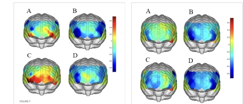 🧠ADICCIÓN A LOS VIDEOS CORTOS (Tik tok)  REDUCE LA ACTIVIDAD CEREBRAL EN EL LÓBULO FRONTAL ⚠️
📜Frontiers in Human Neuroscience encontró que una mayor tendencia a la adicción a videos cortos se asocia con: Cambios en la actividad del lóbulo frontal (corteza prefrontal)
2