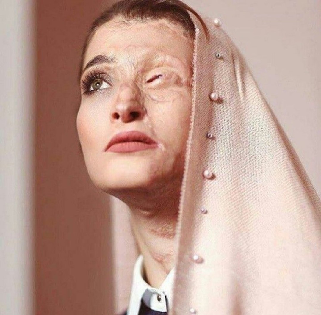 thetatvaindia's tweet photo. Marzieh Ebrahimi was 25 when acid was thrown on her face in Isfahan because she didn't wear hijab.

In 2014 and years that followed, women were attacked for violating dress code and a lot more.

With Khamenei gone, will these girls finally be free from fear? https://t.co/v5UTMYmTG3