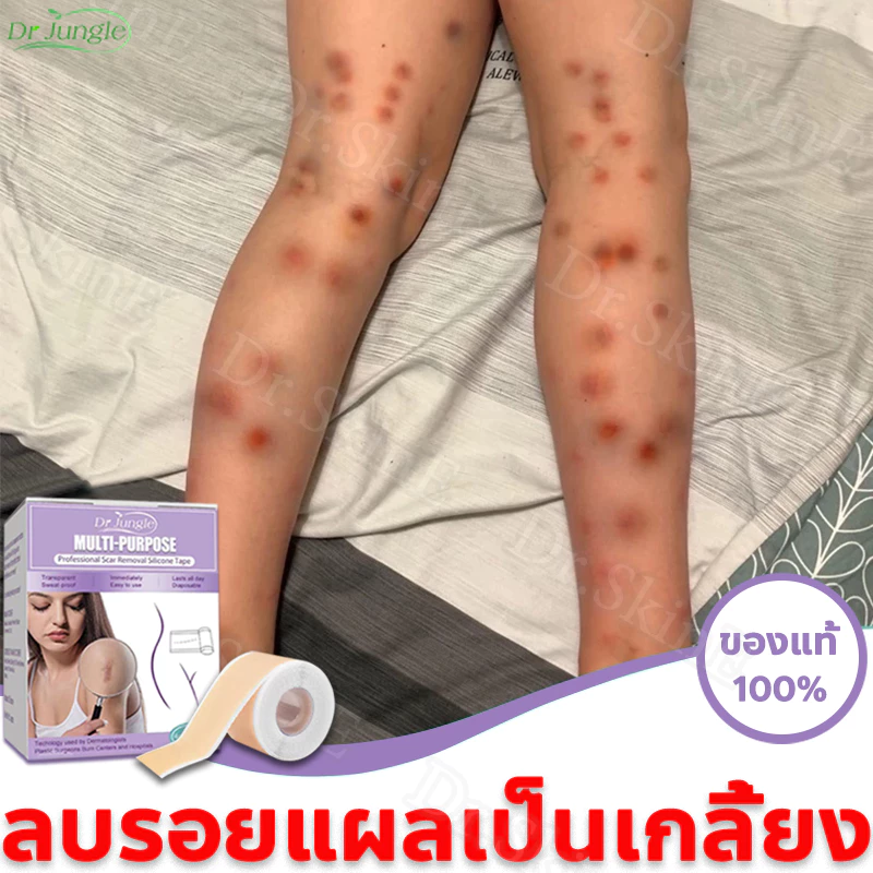 2538_patchara's tweet photo. พิกัดแผ่นซิลิโคน ลอรอยแผลเป็น แผลผ่าตัด (บางคนเอามาแปะรอยสิวก็หายนะ) มีหลายยี่ห้อเลือกตามสภาพผิวเลยจ้า
แบบที่ 1 https://t.co/oy45cYgxGO
แบบที่ 2 https://t.co/6z8WQy1rGh
แบบที่ 3 https://t.co/L15nsYXyaS
แบบที่ 4 https://t.co/wZxPVQD84e

#linglingkwong #หลิงหลิงคอง #หวยงวดนี้ #อิหร่าน #สหรัฐ #อิสราเอล #OLYMPOP #ราคีFanScreeningENGFA