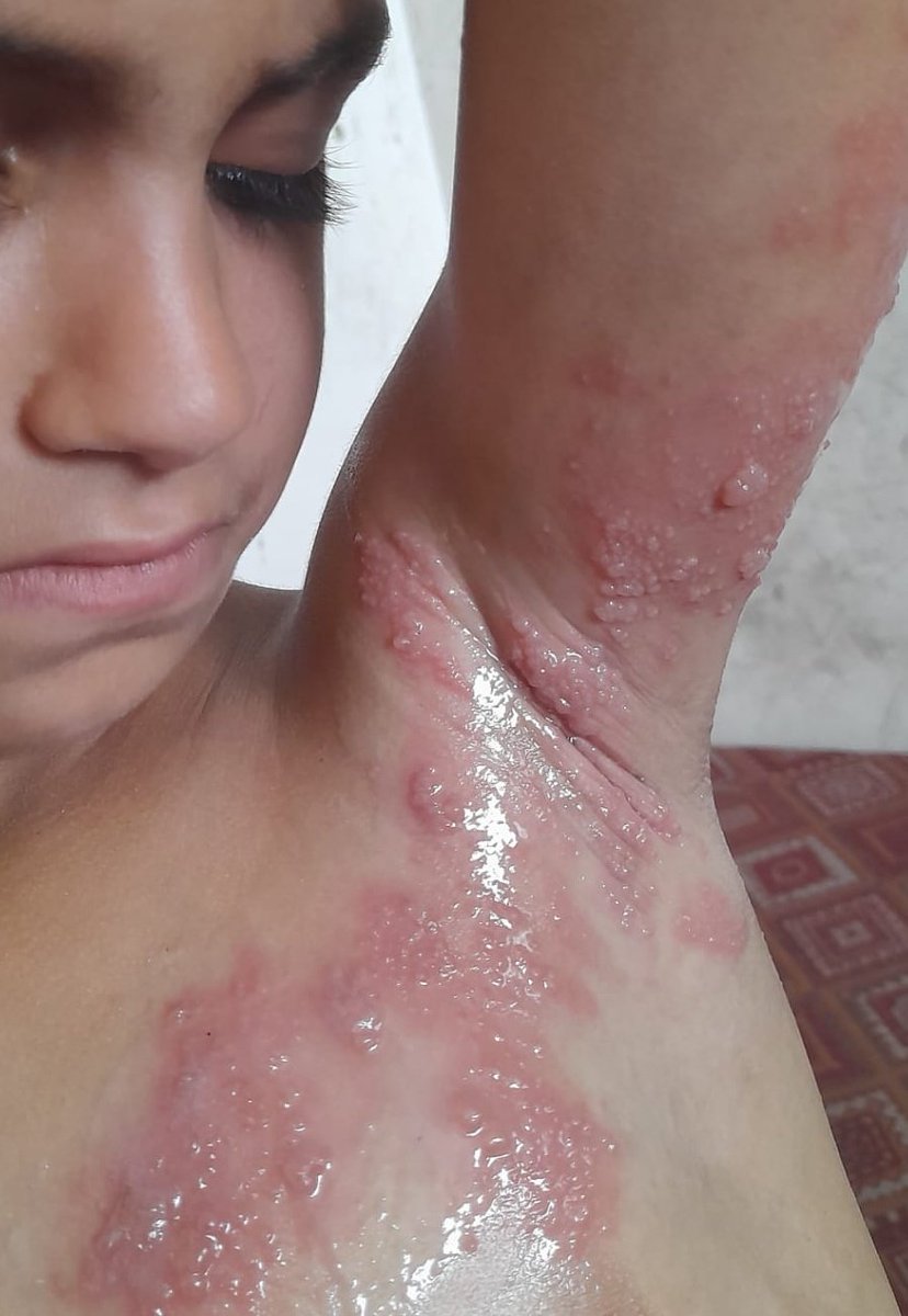 DalulainGaza's tweet photo. WILL DIE😭 

Unfortunately, my poor little sister's body is full of pimples and I can't do anything for her. She urgently needs your help to provide tr

3 replies — even dots — can break the
 algorithm😭 

https://t.co/MfwQOKJDkb https://t.co/9oF6JW38BQ