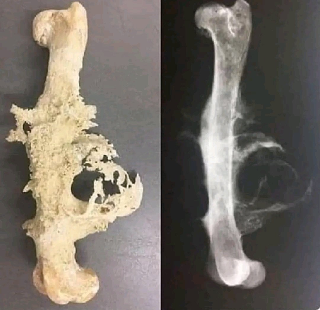 Doctors_GUILD's tweet photo. A presents with pain and swelling around the knee. X-ray shows an aggressive bone lesion with radiating spicules of new bone formation producing “sunburst appearance” 
Diagnosis?

A. Osteosarcoma
B. Osteochondroma
C. Ewing sarcoma
D. Giant cell tumor https://t.co/k2jHeltkpS