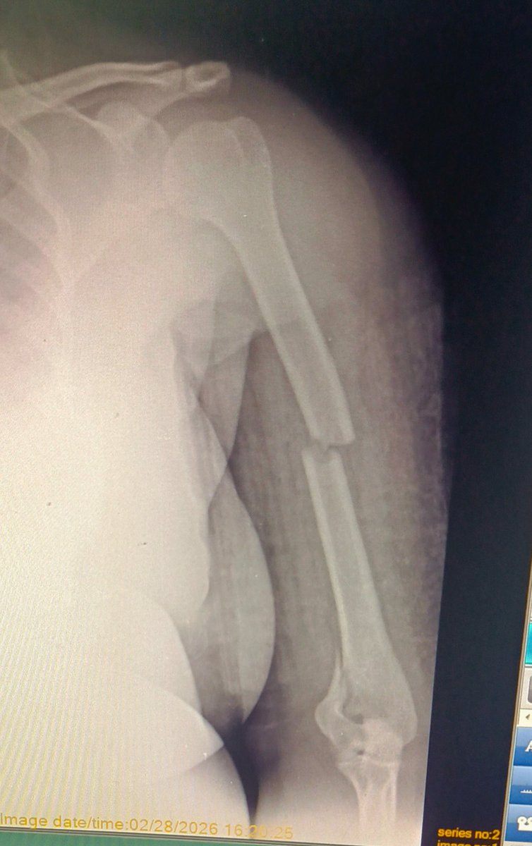 How many fracture lines can be seen here.