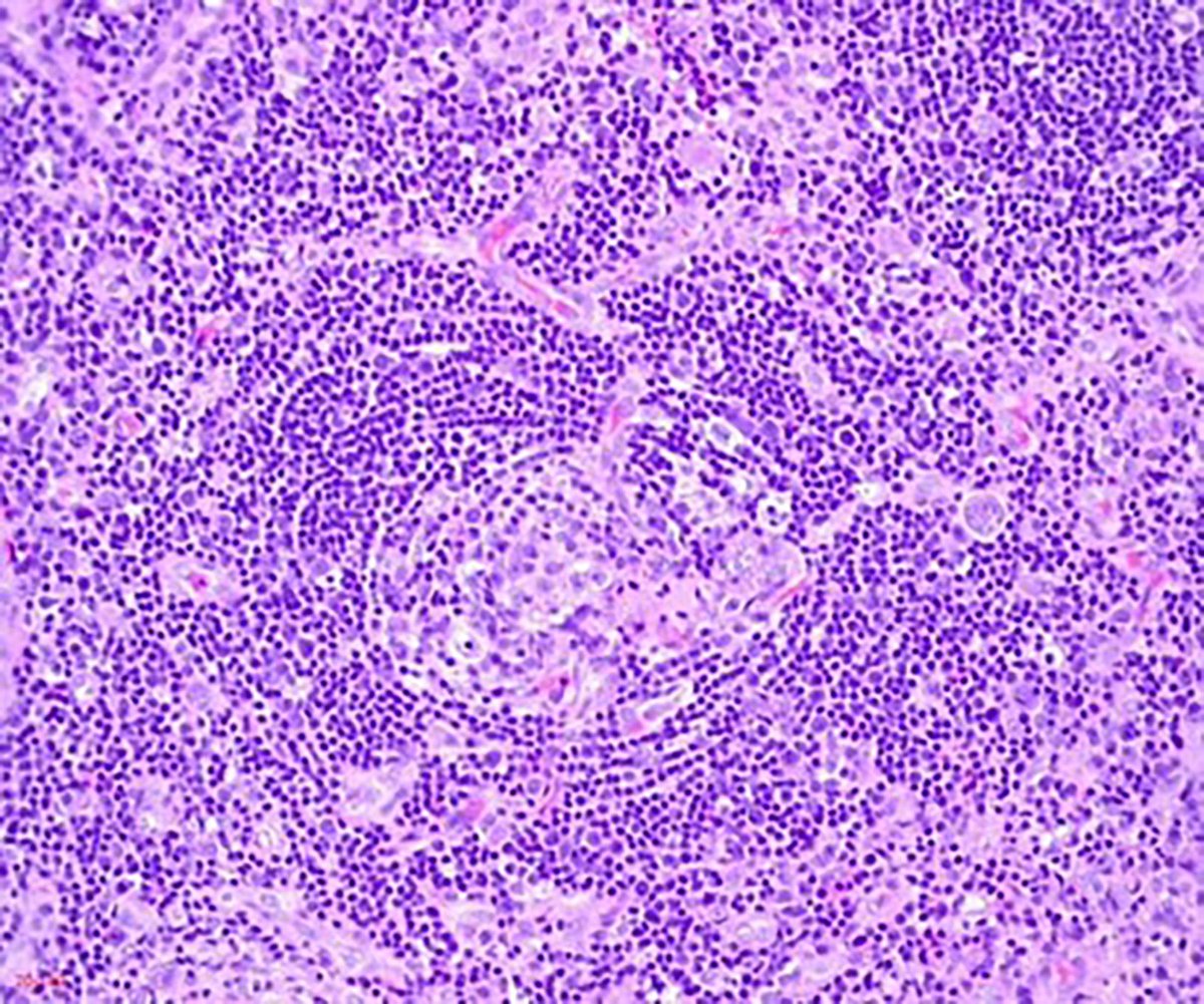 rkalyes1's tweet photo. 🏥 39 /M known ISS on ART presents with B symptoms and is found to have generalized lymphadenopathy.
🔥 He has been unwell for a while but his viral load is undetectable.
👉 Please review the images and results.
🔥 What do you see?
🔥 What is the likely diagnosis?
@TSM_Humanist https://t.co/RmVxWzeUEf