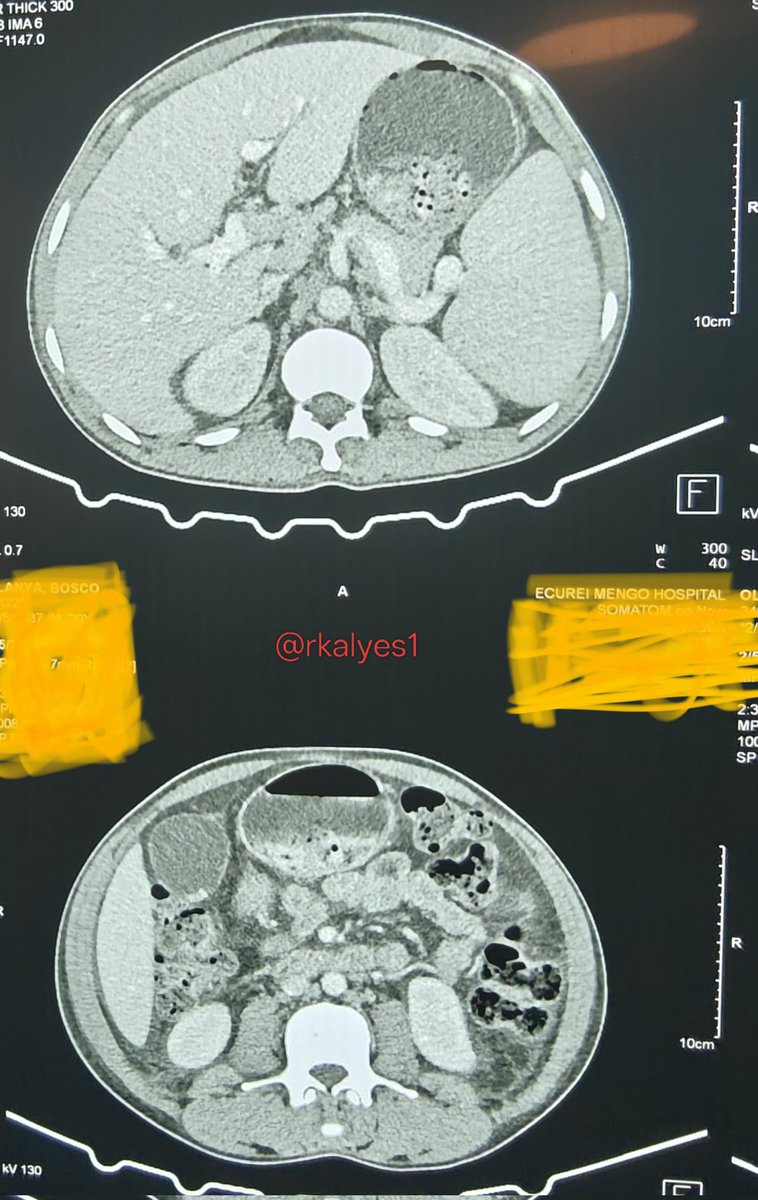 rkalyes1's tweet photo. 🏥 39 /M known ISS on ART presents with B symptoms and is found to have generalized lymphadenopathy.
🔥 He has been unwell for a while but his viral load is undetectable.
👉 Please review the images and results.
🔥 What do you see?
🔥 What is the likely diagnosis?
@TSM_Humanist https://t.co/RmVxWzeUEf