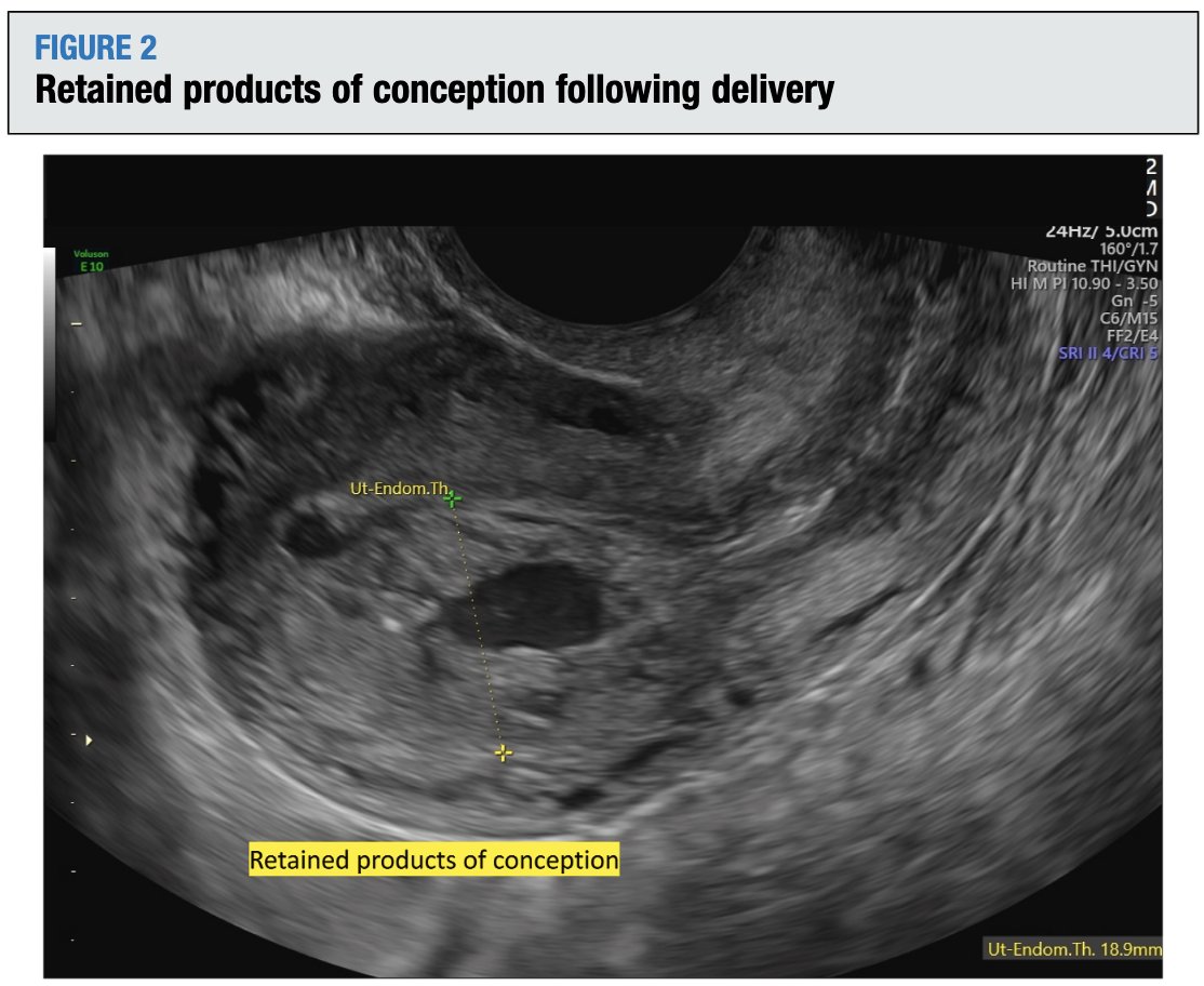 AJOG_thegray's tweet photo. AJOG Expert Review in Cesarean: Infection after cesarean delivery: diagnosis, pathophysiology, management, and prevention https://t.co/UQSOmVW41z https://t.co/3N5b4vvbWs