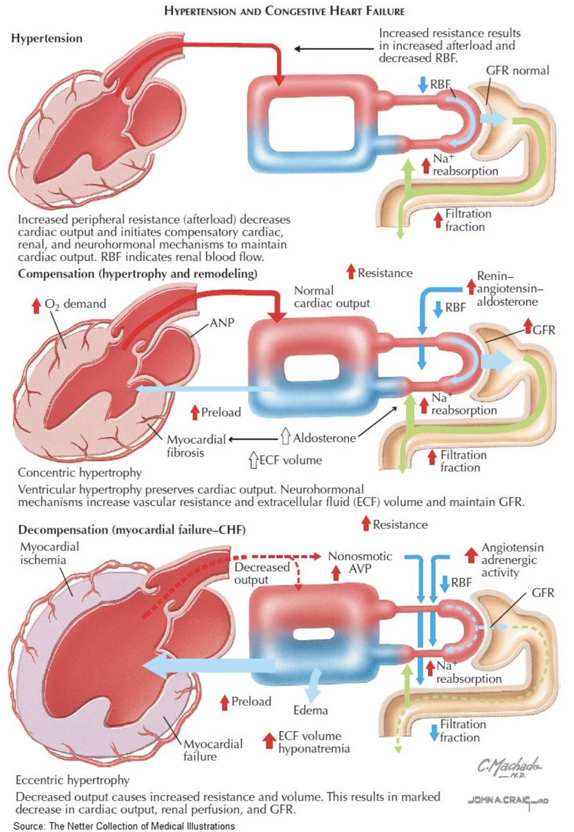 ZainKhalpey's tweet image. Chronic hypertension drives cardiac remodeling, neurohormonal activation, and fluid retention that can ultimately lead to heart failure. 

Early blood pressure control and AI enabled risk prediction are key to prevention.

@ManualOMedicine 

#Hypertension #HeartFailure