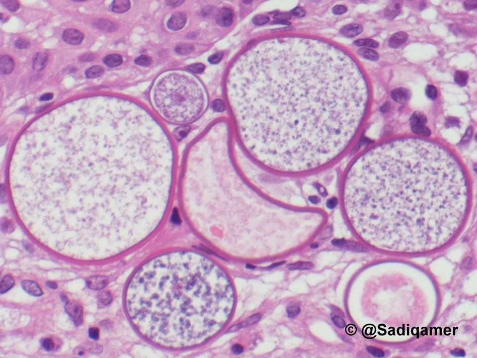 JMGardnerMD's tweet photo. Nasal mucosal mass. Your diagnosis? 
Answer ✅ https://t.co/Bwxqa4fgPy 
More pics here: https://t.co/P96auOX3qc. 
Many thanks to @ sadiqamer for these incredible images! 
#pathology #pathologists #pathTwitter #dermpath #dermatology #dermatologia #dermtwitter #ENTpath #microbiology