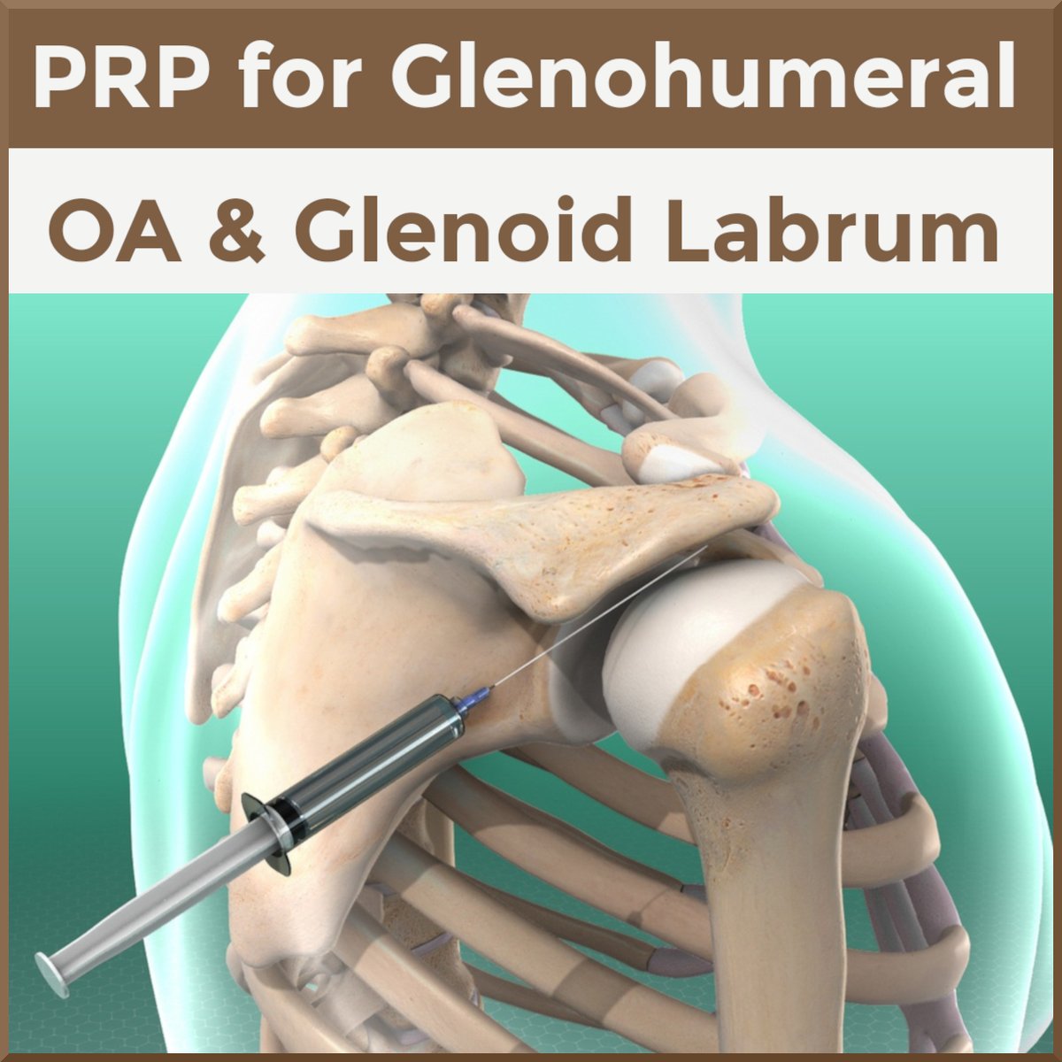 SportsMedReview's tweet photo. Dr. Schleihauf covers PRP for glenohumeral OA and labrum tears in this week's post! 

https://t.co/vNaUmltrZt

#sportsmed #sportsmedicine #ebm #medicine #sports #foamSM #MedEd #FOAMed #ortho #medtwitter #OrthoTwitter https://t.co/QhjwWPZsul