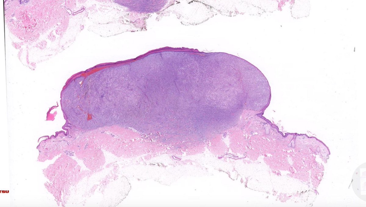 JMGardnerMD's tweet photo. 65 yo man with rapidly growing ulcerated black nodule on back. 
WSI digital slide: https://t.co/9gr4CNWTYX
Answer ✅  https://t.co/5A80donHz0 
#BSTpath #pathology #pathologists #pathTwitter #dermpath #dermatology #dermatologia #dermtwitter https://t.co/GHqNjiOlNy