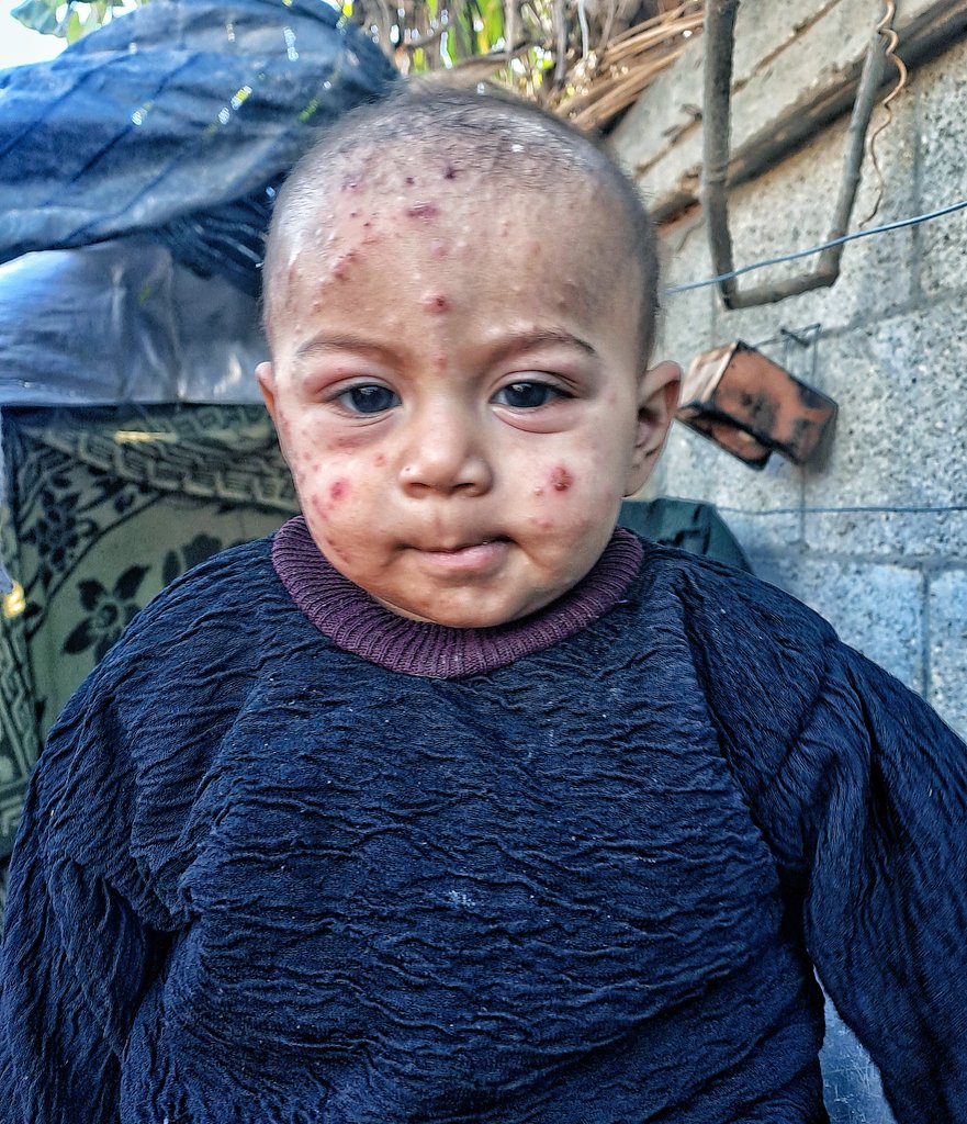 The rashes continue to spread across her small face, and her swollen eyes show how much she is suffering. She cries quietly, exhausted from the constant burning and itching that never leave her. Even simple rest has become difficult for her fragile body. She is just a child, but