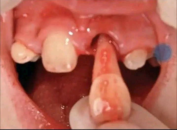 Someone just knocked out a tooth? 
Don't panic!
If it’s a permanent tooth, it can be reimplanted back into its original position… but time is critical.

Here’s what to do immediately:

1️⃣ Pick it up by the crown (the white part), NOT the root.
2️⃣If dirty, gently rinse with clean