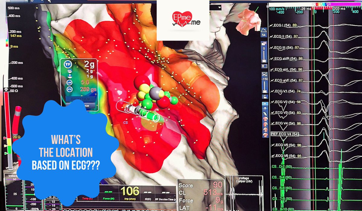 EPmedotme's tweet photo. What’s the location based on ECG??? Where would you ablate?? #EPeeps #cardiacablation #ensiteX #vpbs #electrophysiology #cardiology https://t.co/76BuOBc3oN