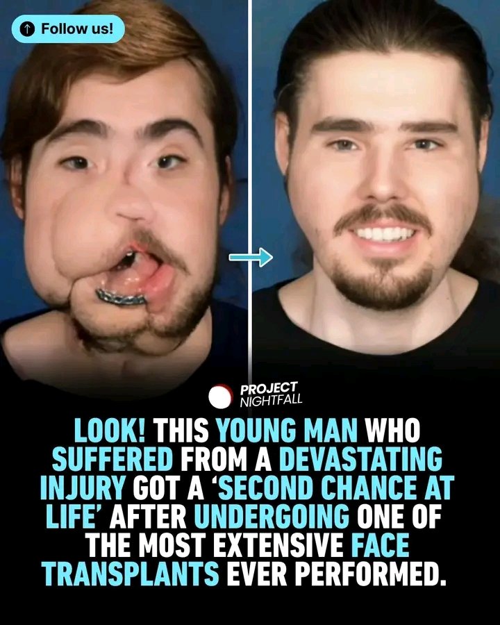 The_vine11's tweet photo. At 24 years old, his life changed in a single moment.

A gunshot wound destroyed most of Cameron Underwood’s lower face in 2016. He lost the majority of his lower jaw, his nose, and all but one tooth. #Resilience #MedicalBreakthrough #SecondChance https://t.co/meO5PB5Z7y