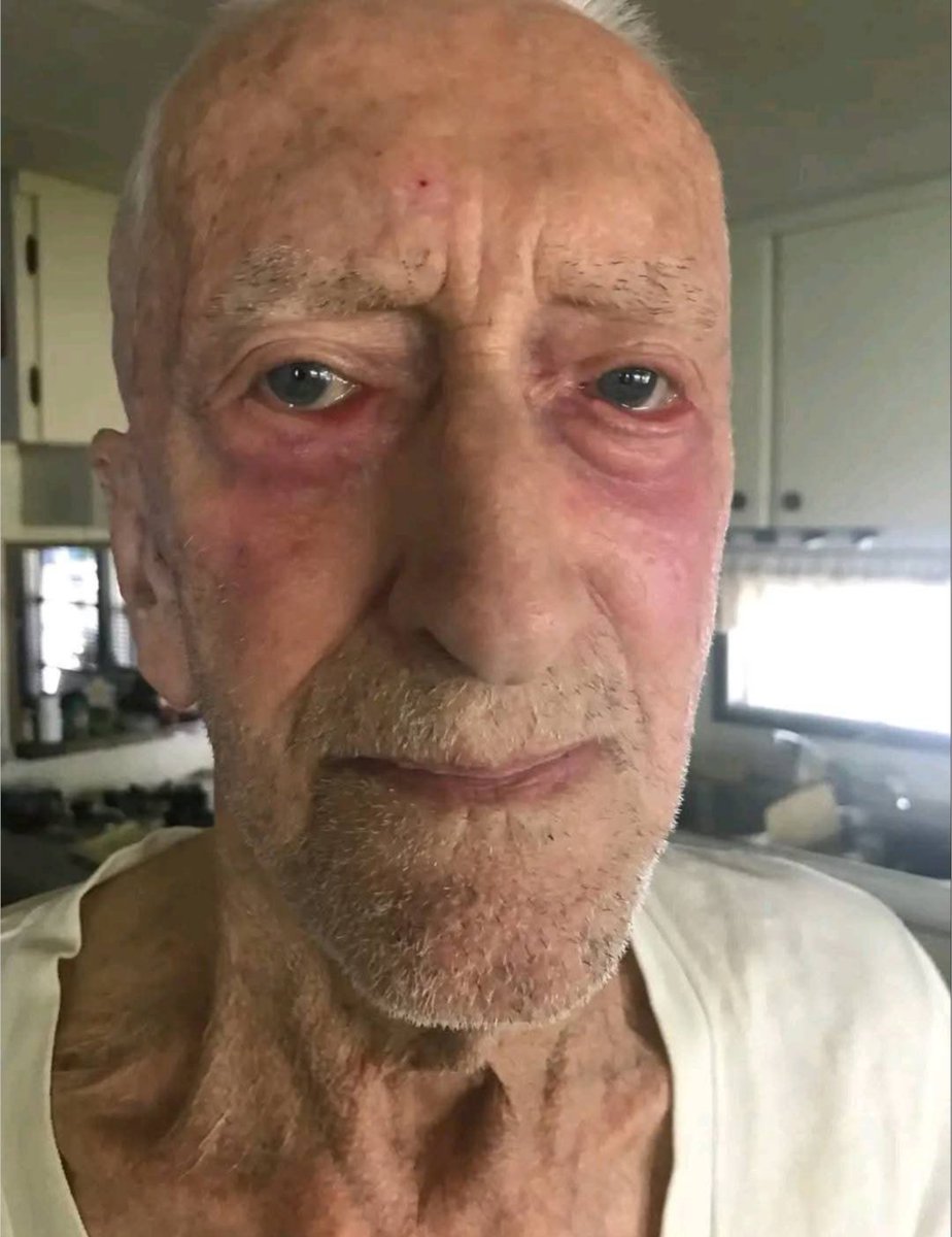 IVERMECTIN Topical Cream Testimonial - 88 year old Alberta farmer with  skin Cancer has 4 tubes of Ivermectin paste sent to him by his son

More and more Topical Ivermectin testimonials are starting to come in...

88 year old farmer in Alberta was diagnosed with skin cancer 

His