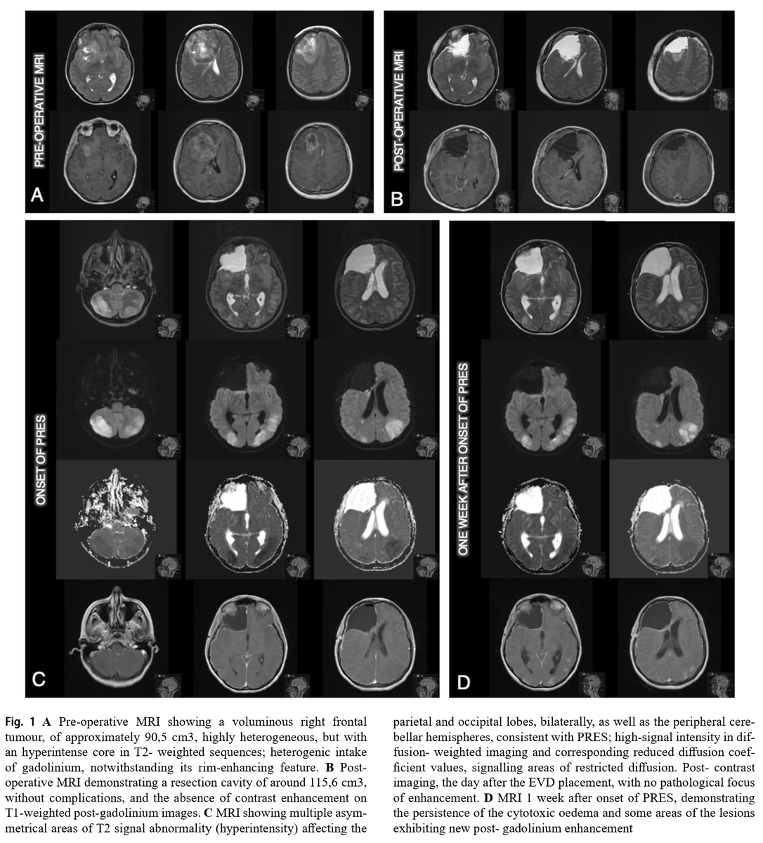 King's Neurosurgery tweet media