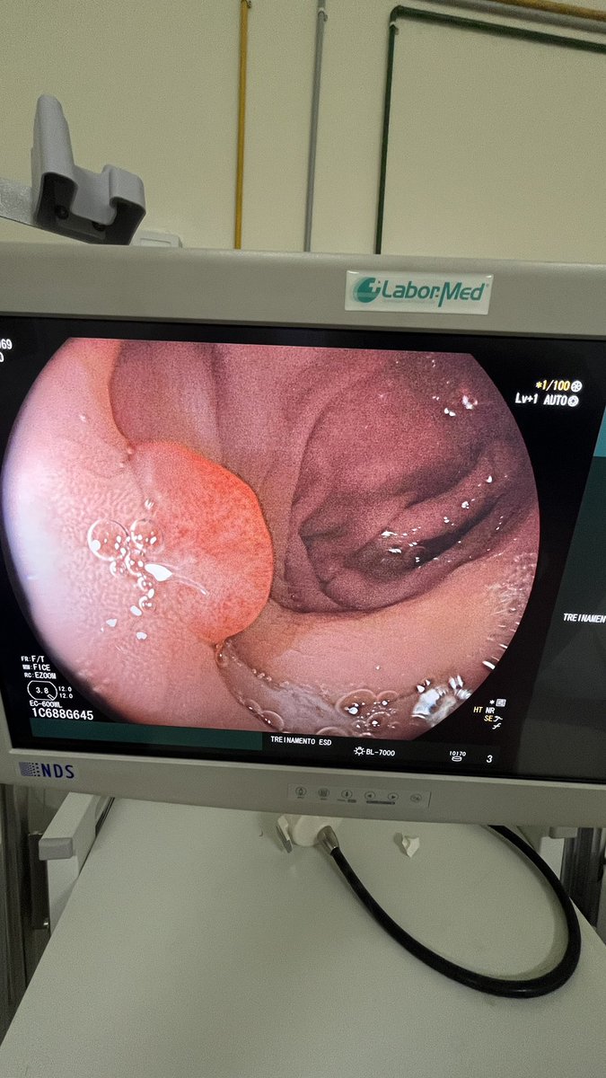 luciacolorectal's tweet photo. 100 #colonoscopies with many #polyps in the first day of our mission in #bahia
@campanhamarcoazul #marchblue https://t.co/AqGWovcmqB