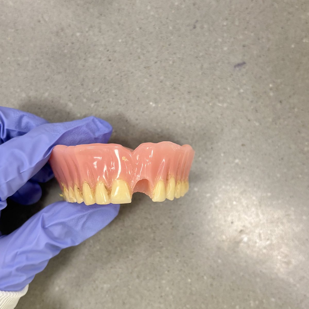 blcspot's tweet photo. Denture repair, before and after 🤌🏻 https://t.co/a4z98SyZBo