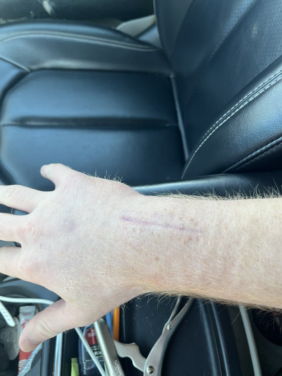 My cast came off a week early!!

<a href="/CoachAUWL/">Mike Anderson</a> <a href="/_Coach_McCall/">Andre McCall</a> <a href="/CoachMalc_4/">Malcolm Henry</a> <a href="/CoachRodrckPlum/">Roderick Plummer</a>  <a href="/CoachLukeOlson/">Coach Luke Olson</a> <a href="/ChayceMontagne1/">Chayce Montagne</a> <a href="/CoachJ_USF/">Alex Johnson</a> <a href="/coach_atownsend/">Alex Townsend</a> <a href="/NewBobDaviesFB/">Bob Davies</a> <a href="/CoachMZweifel/">Michael Zweifel</a> <a href="/krausejake80/">Jake Krause</a> <a href="/CoachKoleMack/">Kole Mack</a> <a href="/CoachRGoode/">Rob Goode</a> <a href="/tj_wiu/">T.J. Haws</a> <a href="/CoachSchafer4/">Ty Schafer</a> <a href="/CoachWiese/">Curt Wiese</a> <a href="/CoachSommerlot/">Luke Sommerlot</a>