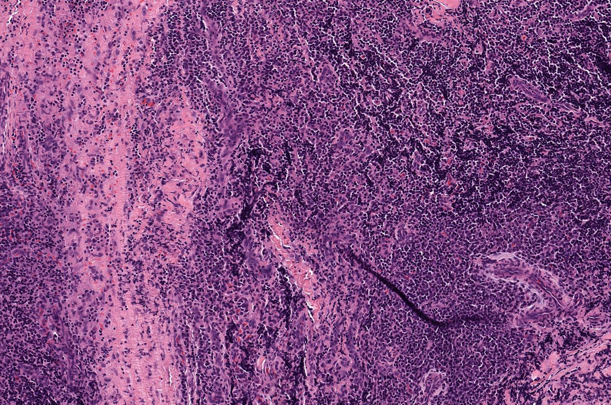 JMGardnerMD's tweet photo. 9 yo F. Back nodule. Clinical dx: lipoma vs cyst. Stain: ALK1.
Answer ✅ https://t.co/VBFWkx2dEA 
Digital slides: https://t.co/fCiNctDuHf
More Stains: https://t.co/j2n8z6erPX
#pathology #pathologists #pathTwitter #dermpath #dermatology #dermatologia #dermtwitter #BSTpath https://t.co/HDDej3wgid