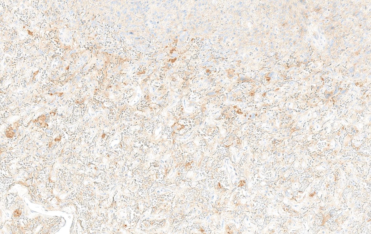JMGardnerMD's tweet photo. 9 yo F. Back nodule. Clinical dx: lipoma vs cyst. Stain: ALK1.
Answer ✅ https://t.co/VBFWkx2dEA 
Digital slides: https://t.co/fCiNctDuHf
More Stains: https://t.co/j2n8z6erPX
#pathology #pathologists #pathTwitter #dermpath #dermatology #dermatologia #dermtwitter #BSTpath https://t.co/HDDej3wgid