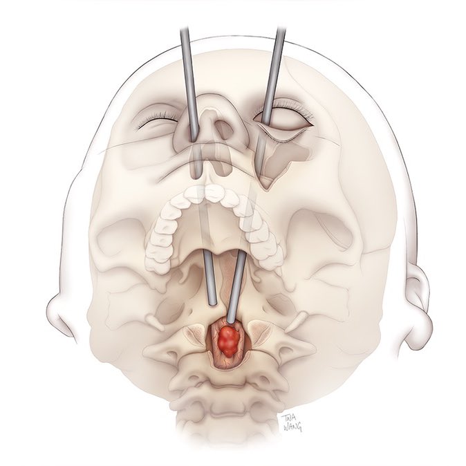 🔴 Cirujanos acaban de extirpar un tumor espinal a través de una cuenca ocular en una operación pionera a nivel mundial.