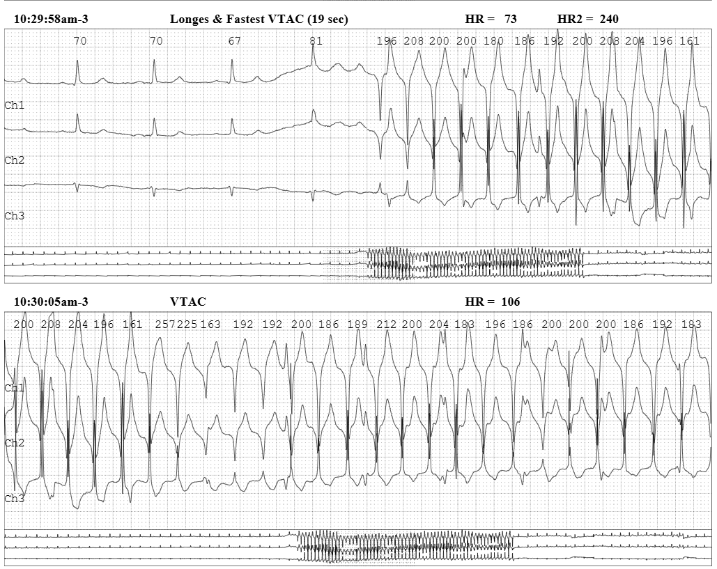 syamkumarmd's tweet image. Diagnosis? SVT or VT? #EPeeps