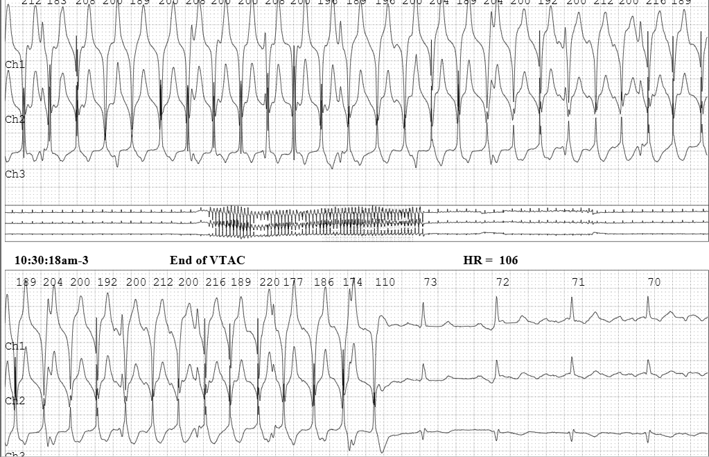 syamkumarmd's tweet image. Diagnosis? SVT or VT? #EPeeps