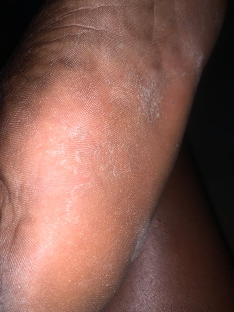 Please what causes peeling of skin on the feet?🤧 My feet are so rough.