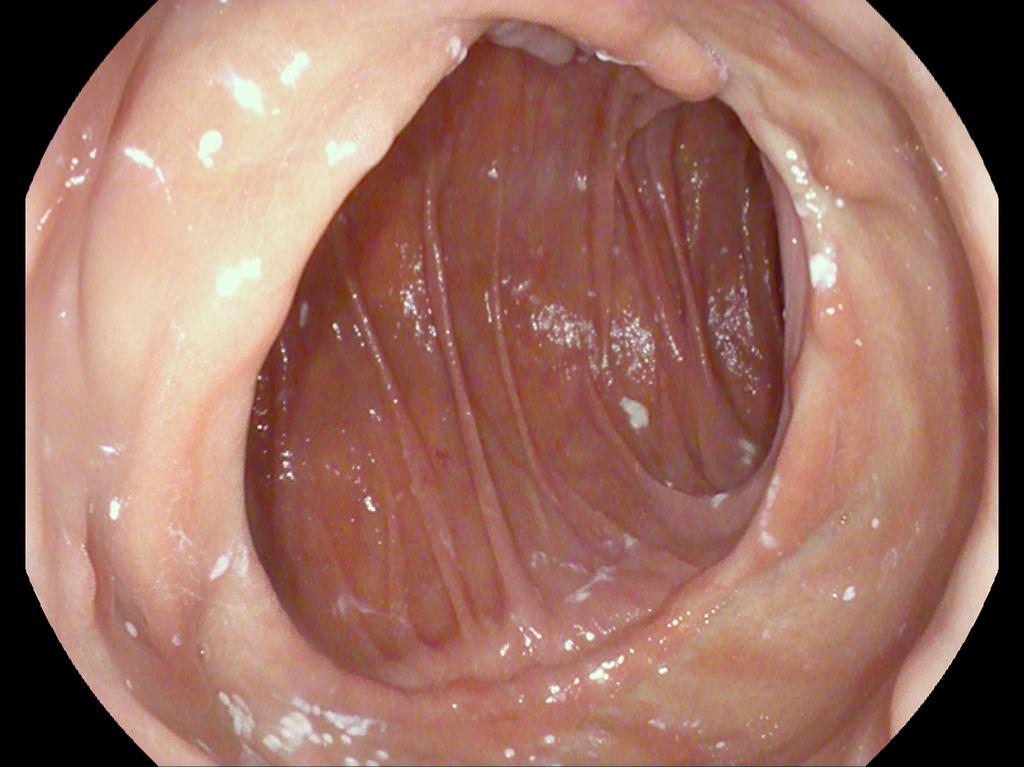 _pabloarg's tweet photo. 🚀Realizamos nuestro primer #TORe con #OverStitch para el  tratamiento del síndrome de dumping refractario. 
🤝Un trabajo en equipo que beneficia a los pacientes con esta grave complicación del by-pass gástrico. 

#bariatricendoscopy https://t.co/EBQCoXKAbw