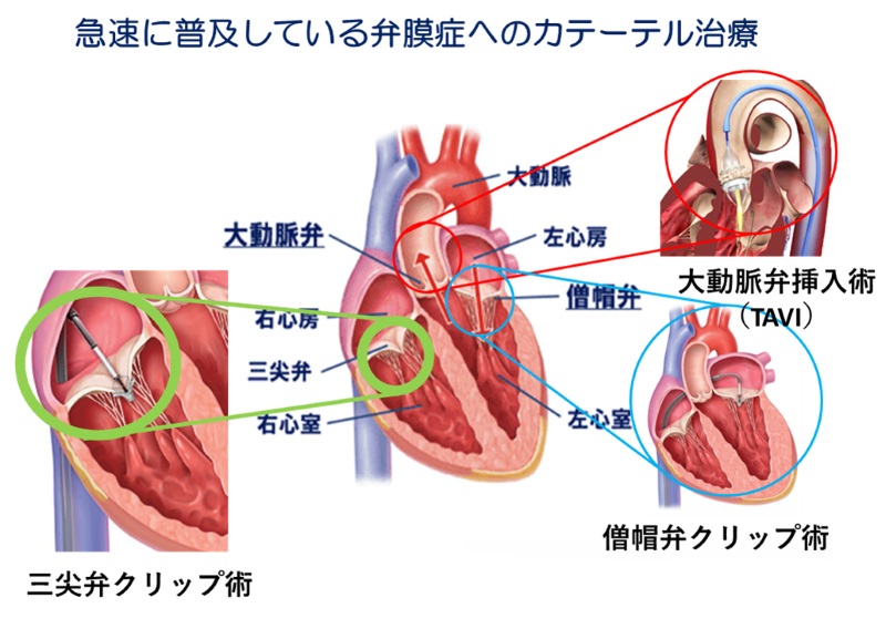 NCVC_official's tweet photo. 【プレスリリース】
#国循 の弁膜症治療チームは「TriClip」を用いた三尖弁閉鎖不全症に対するカテーテル治療を2026年3月2日に西日本で保険承認後初めて実施しました。
#NCVC
https://t.co/ry0J6J2jlM https://t.co/s6LZogVGnL