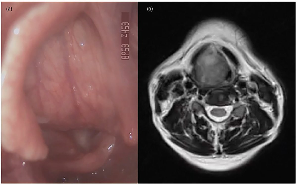 Logopedics Phoniatrics Vocology tweet media