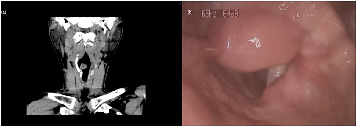 Logopedics Phoniatrics Vocology tweet media