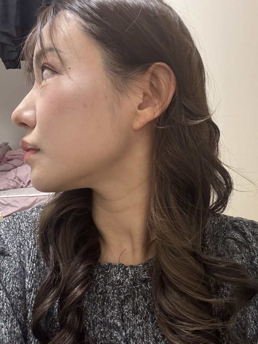 seikeichandayo's tweet photo. @onulpsjapan 輪郭三点＋皮質骨除去＋咬筋縮小＋顎先筋肉引き締め固定 ＋貴族手術
２ヶ月後📝
もううまく笑えるようになってきた！
笑った時の引きつりがましになった！顎らへんは少し麻痺してる🤏
これでもまだ少し腫れてるらしく変化楽しみでしかない！！✨
#onulpsjapan https://t.co/HTAhEGMxGW