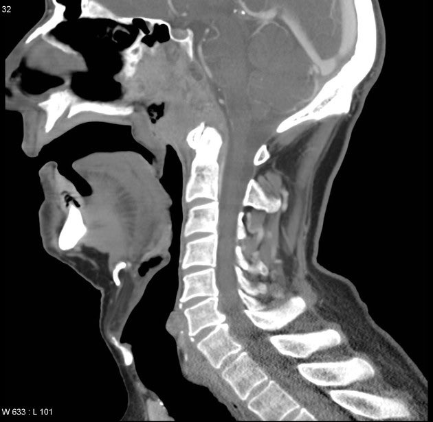 Sagital bone window of a CT scan showing an isodense lesion in the Nasopharynx with skull base infiltration . Nasopharyngeal Tumour most likely