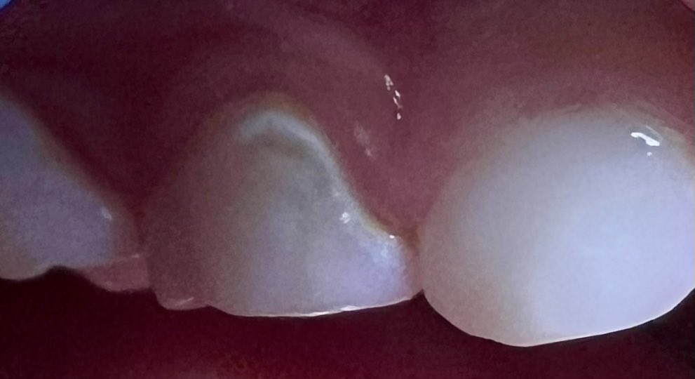 clarabolism's tweet photo. 🦷 ¡PAPÁS, ojo aquí! ¿Vieron una mancha blanca opaca en los dientes de tu peque? 😟  
¡Es la etapa INICIAL de caries! (desmineralización del esmalte)  
Buena noticia: se puede re mineralizar.
No es solo "manchita"... es aviso de caries temprana. https://t.co/eCXlFmLFC4