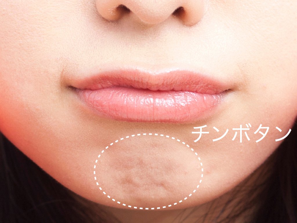 「口呼吸か鼻呼吸かをチェックする方法」はまだあります。
例えば
「口を閉じるとチンボタンができる」です。
「チンボタン」というのは下顎の先端の膨らみにできる「梅干しの種のような筋肉の緊張」です。
その人にとってチンボタンができるほど
歯が前に飛び出しすぎていると、